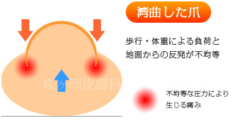 巻爪(湾曲した爪)